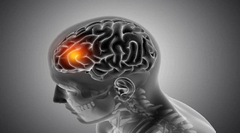 Brain Stroke: માથાનો દુખાવો કે ચક્કર આવવા, આ ખૂબ જ સામાન્ય લક્ષણોને ન કરો નજરઅંદાજ, બ્રેઈન સ્ટ્રોકનો વધી શકે છે સંકટ