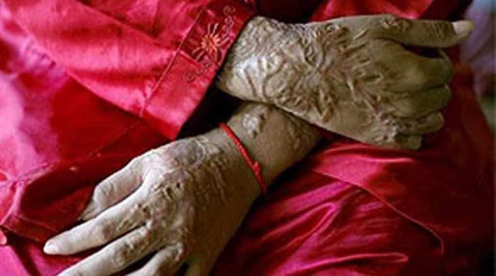 Acid Attack First Aid:એસિડથી સ્કિન દાઝી જાય તો આ રીતે કરો પ્રાથમિક સારવાર, આ બાબતનું રાખો ખાસ ધ્યાન