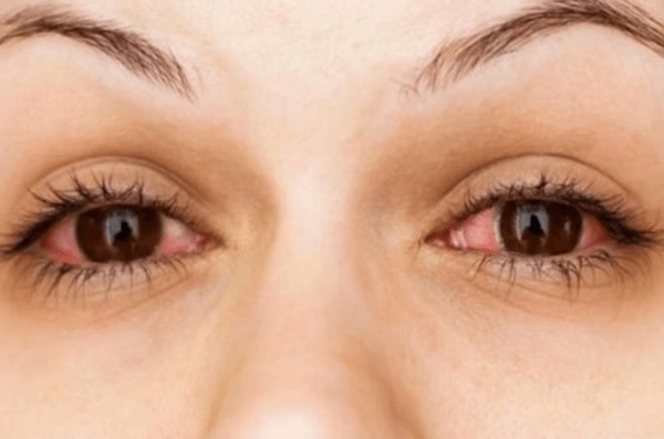 સૂર્યના તીવ્ર કિરણોને કારણે આંખની સમસ્યા થાય છે. આ કિરણો અલ્ટ્રાવાયોલેટના રૂપમાં હોય છે. ઉનાળામાં આંખની સમસ્યા વધુ જોવા મળે છે. આ સમયગાળા દરમિયાન આંખની સંભાળ રાખવા માટે કેટલાક પગલાં લઈ શકાય છે. અમે તમને આ ઉપાય વિશે માહિતી આપીશું.