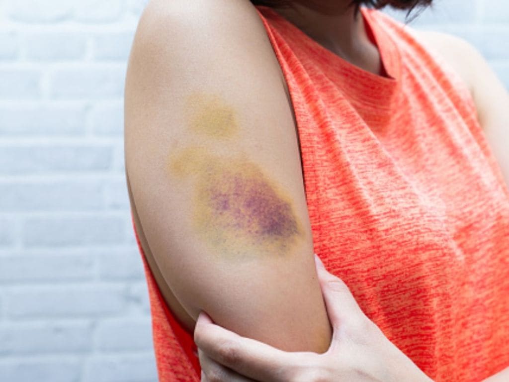 Health Tips : શરીર પર ન સમજાય તેવા ઉઝરડા થવાનું કારણ શું છે?