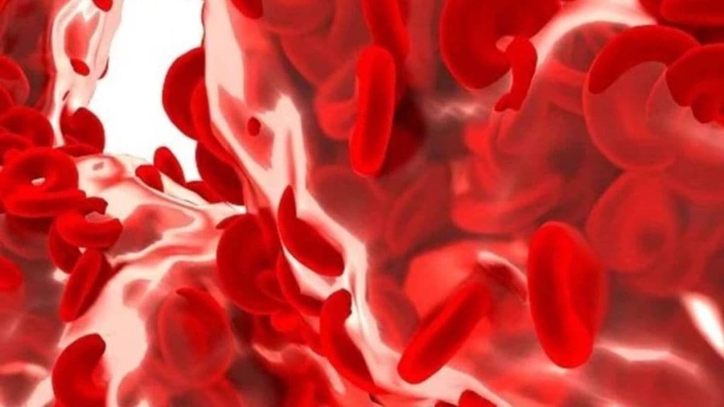 Sickle Cell Disease : સિકલ સેલ એનિમિયા અંદાજ કરતા 11 ગણો ઘાતક, અભ્યાસ દ્વારા જાણવા મળ્યું
