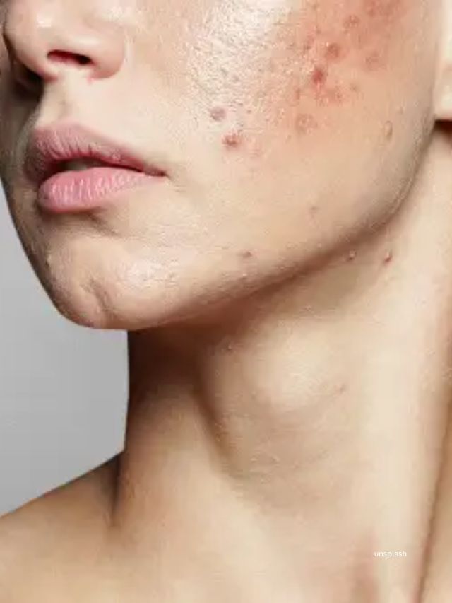 ખીલ, કોઈ ઘા વગેરેના લીધે ફેસ પર ડાઘ પડે છે, જે હટાવવા માટે ઘણા ઘરેલુ ઉપાય છે. આ ઘરેલુ નુસખાની મદદથી ફેસ પરના ડાઘ દૂર કરી શકીએ છીએ.