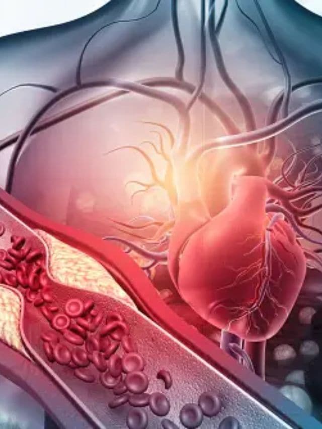 હાઈ કોલેસ્ટ્રોલ માટે ડાયટ ખૂબ જ જવાબદાર પરિબળ છે. ડાયટમાં સંતૃપ્ત ચરબી, તેલયુક્ત ખોરાક અને ટ્રાન્સ ફેટના સેવનથી ખરાબ કોલેસ્ટ્રોલ ઝડપથી વધે છે.