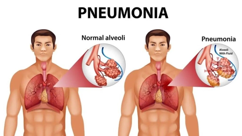 Pneumonia Diet: ન્યુમોનિયામાં આ 4 ચીજનું સેવન રાહત આપશે, ઝડપથી સાજા થશો