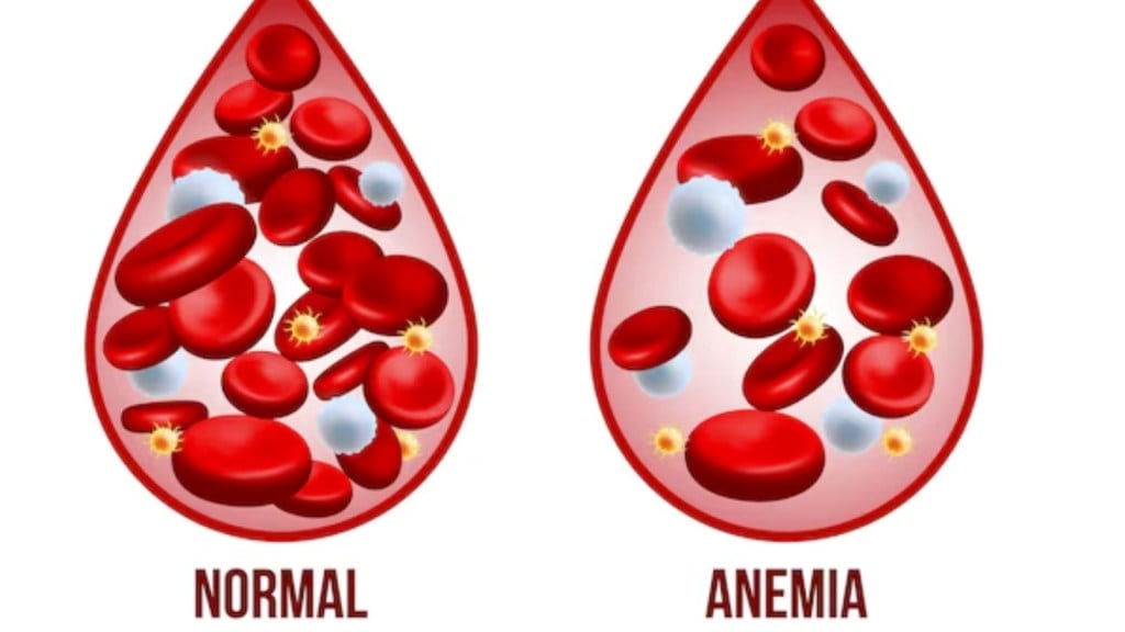 Hemoglobin Deficiency : હિમોગ્લોબિનનું ઉણપના કારણો, લક્ષણો અને સારવાર વિષે જાણો? એક્સપર્ટ શું કહે છે?