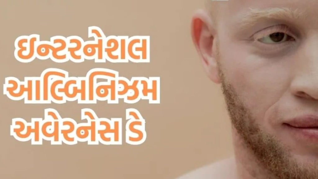 International Albinism Awareness Day 2024 : કેમ મનાવવામાં આવે છે ઇન્ટરનેશનલ આલ્બિનિઝમ અવેરનેસ ડે, જાણો