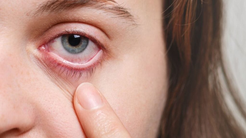 Conjunctivitis: કન્જેક્ટિવાઇટિસ આંખોનું દુશ્મન, ચોમાસામાં આંખ આવે ત્યારે આટલી સાવધાની રાખવી Conjunctivitis: કન્જેક્ટિવાઇટિસ આંખોનું દુશ્મન, ચોમાસામાં આંખ આવે ત્યારે આટલી સાવધાની રાખવી