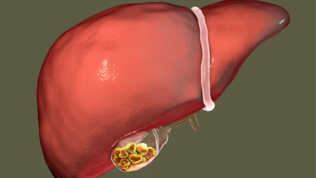 gallstone cause