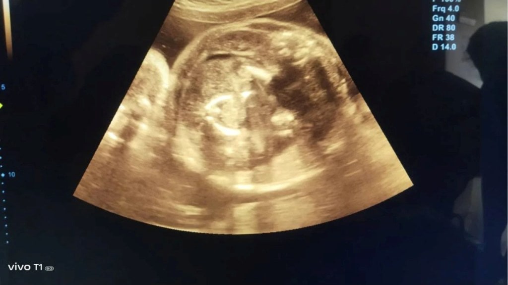 OMG! સગર્ભા મહિલાના પેટમાં બાળક અને… બાળકના પેટમાં પણ ‘બાળક’! ખૂબ જ દુર્લભ ઘટના OMG! સગર્ભા મહિલાના પેટમાં બાળક અને… બાળકના પેટમાં પણ ‘બાળક’! ખૂબ જ દુર્લભ ઘટના