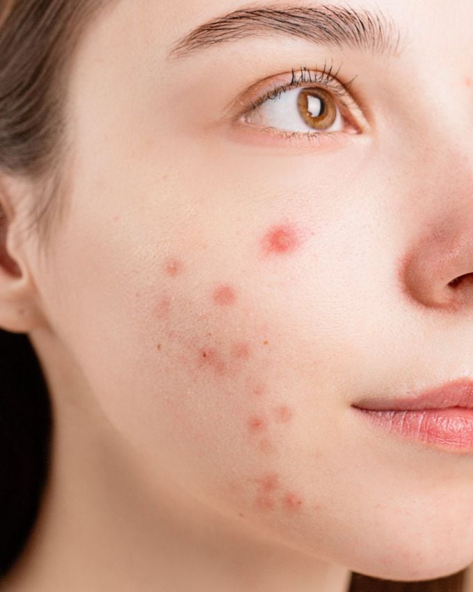 કેટલાક ખીલથી પરેશાન છે, તો કેટલાક ડ્રાય સ્કિન માટે વિવિધ પ્રકારના ઉપાયો અને માર્કેટ પ્રોડક્ટસનો ઉપયોગ કરી રહ્યા છે. પરંતુ શું તમે જાણો છો કે શરીરમાં કેટલાક એવા વિટામિન્સ છે જેની ઉણપથી ત્વચા સંબંધિત સમસ્યાઓ થાય છે. જો આ વિટામિન્સની ઉણપ દૂર કરવામાં આવે તો ત્વચા સ્વસ્થ, સ્વચ્છ અને ચમકદાર બને છે. આવો જાણીએ કયા એવા વિટામિન છે જેની ઉણપથી સ્કિનની સમસ્યા થાય છે.