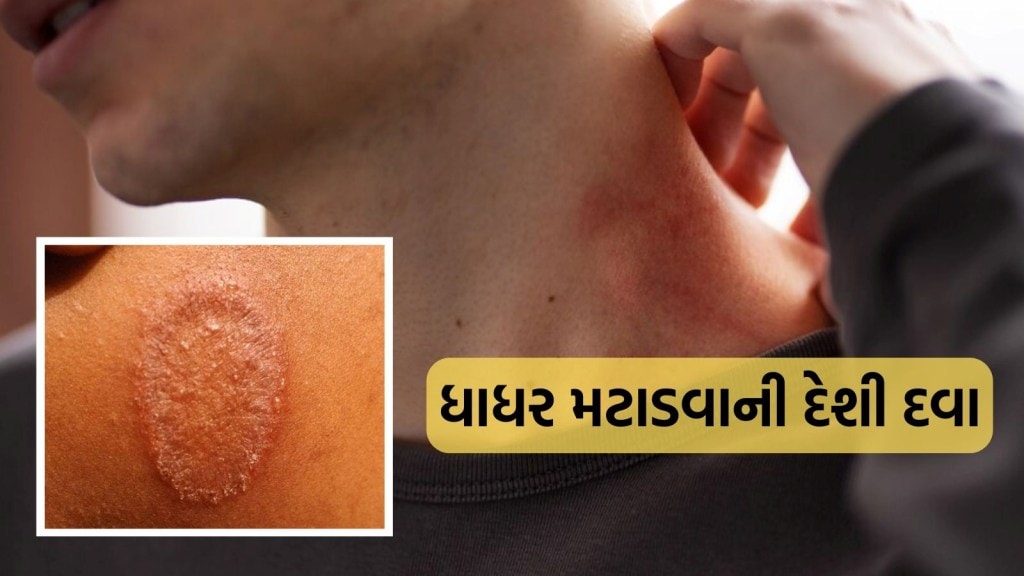 ધાધર મટાડવાની દેશી દવા, આ આયુર્વેદિક ઉપાયોથી મળી જશે કાયમી છુટકારો