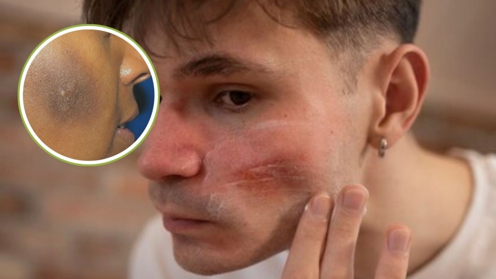 ચહેરા પરના કાળા ડાઘ કેવી રીતે દૂર કરવા, આ રહ્યા કપાળ પર પડેલા કાળા ડાઘ દૂર કરવાના ઘરગથ્થુ ઉપાયો