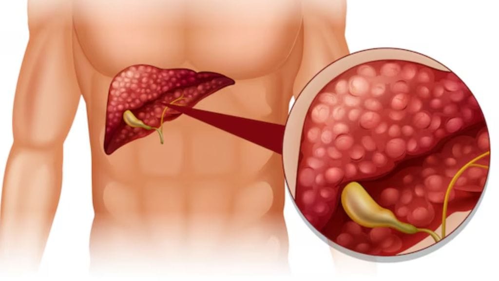 Fatty Liver Reducing Diet Tips | ફેટી લીવર ઘટાડવાની ડાયટ ટિપ્સ, જલ્દી મળશે સમસ્યાથી છુટકારો