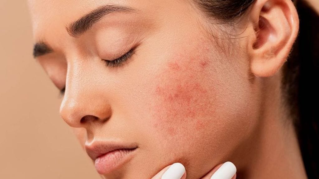 Acne Healing Tips In Gujarati | ખીલથી છુટકારો મેળવવા માટે કરો આ પાવડરનો ઉપયોગ, થશે ફાયદા