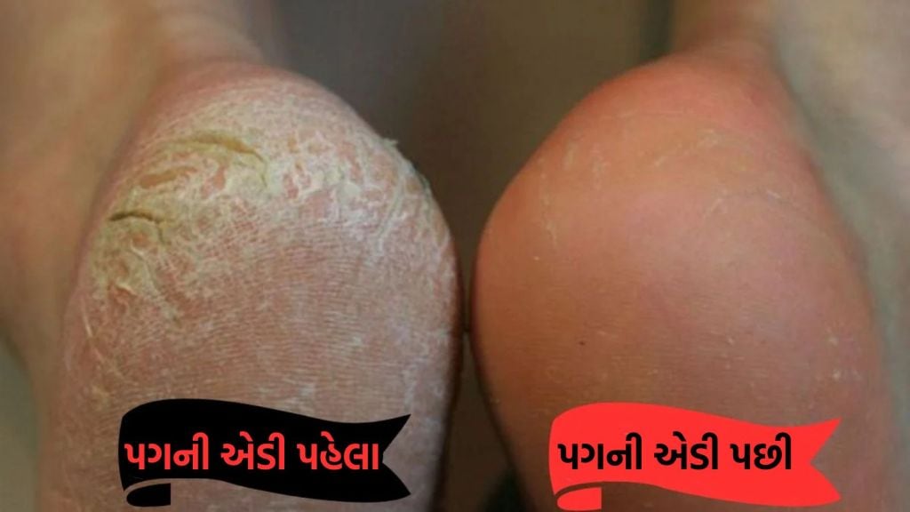 Cracked Heels Remedy : શિયાળામાં પગની એડી ફાટી ગઇ છે? રાતે સુતા પહેલા કરો આ ઘરેલું ઉપાય, પગના વાઢિયા મટાડશે
