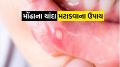 Health Tips : મોંઢામાં ચાંદા વારંવાર થાય છે? બાબા રામદેવના 5 આયુર્વેદિક ઉપાયોથી તાત્કાલિક રાહત મળશે mouth ulcer | mouth ulcer tips | mo na chanda na upay | mukh ke chhallo ka upay